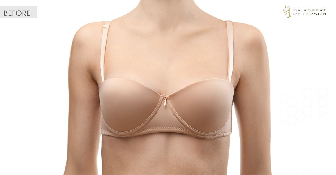Before-Breast Lift With Augmentation