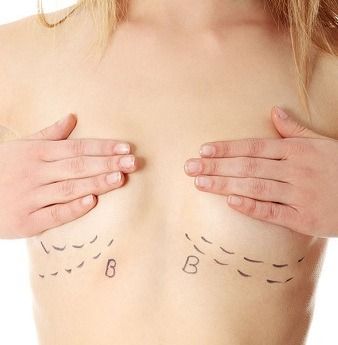 Breast Reduction Houston – Mammoplasty