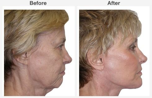 endoscopic brow lift face lift neck lift 1 2