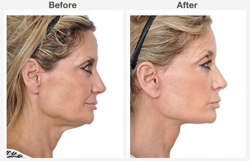 endoscopic brow lift face lift neck lift 3 3
