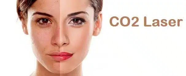 Laser Skin Resurfacing Houston