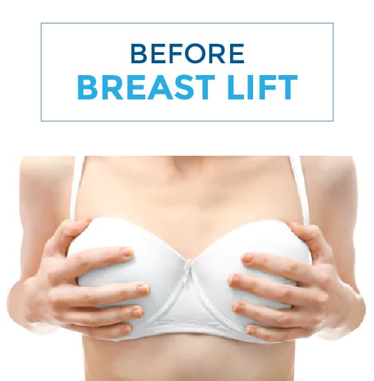Breast Lift Before After 01