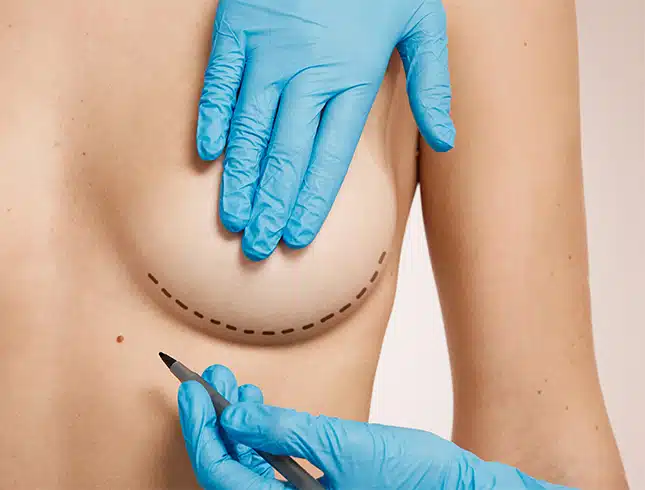 breast implant removal 645x490 1