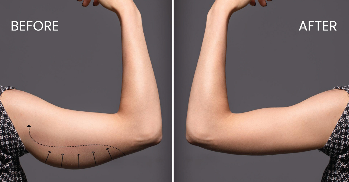 Before and after image of arm fat removal treatment.