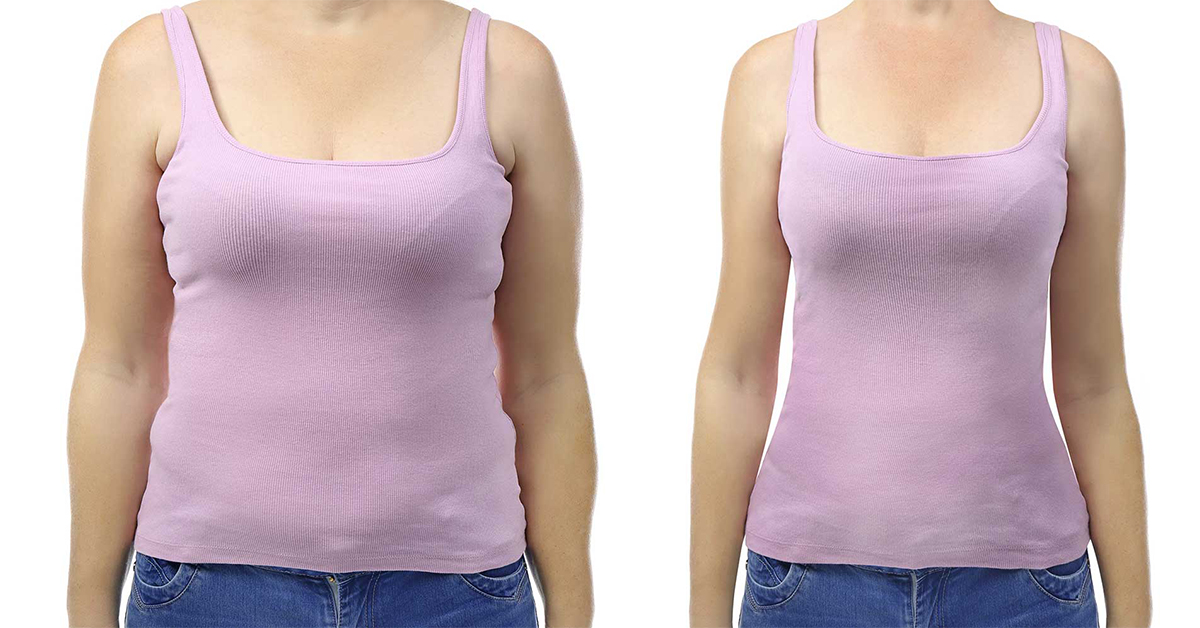 breast reduction before or after weight loss